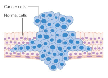 diagram-showing-a-tumour-forcing-its-way-through-normal-tissue